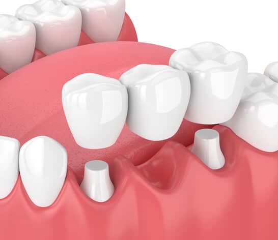 What are Dental Bridges (1)