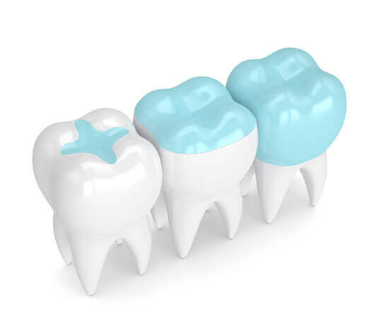 What are Dental Fillings
