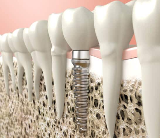 What are Dental Implants