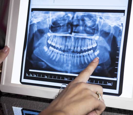 What are Dental X-Rays