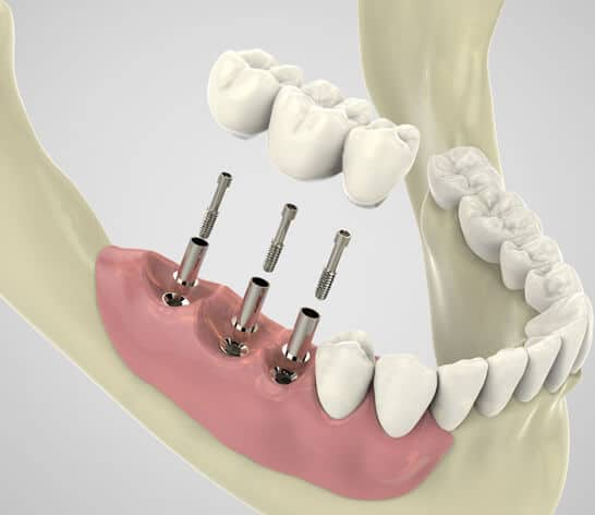 What are Implant Restorations