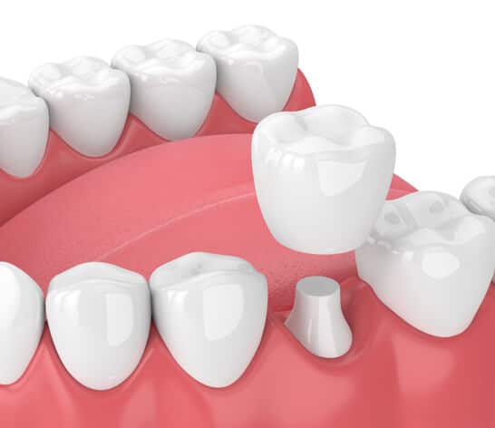 What are Porcelain Crowns