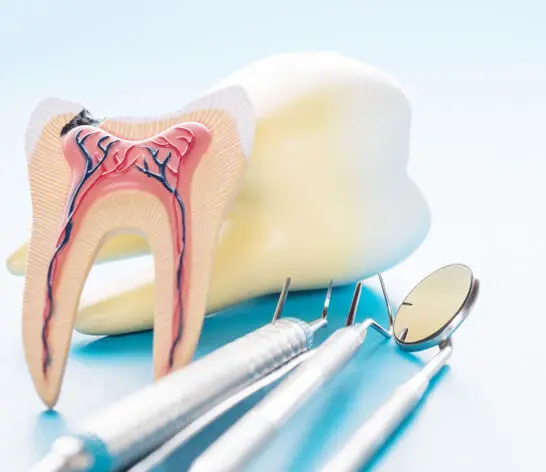 Root canal procedure