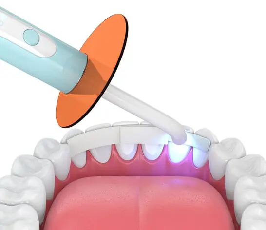 What is Dental Bonding