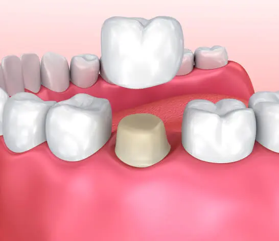 candidate for Porcelain Crowns