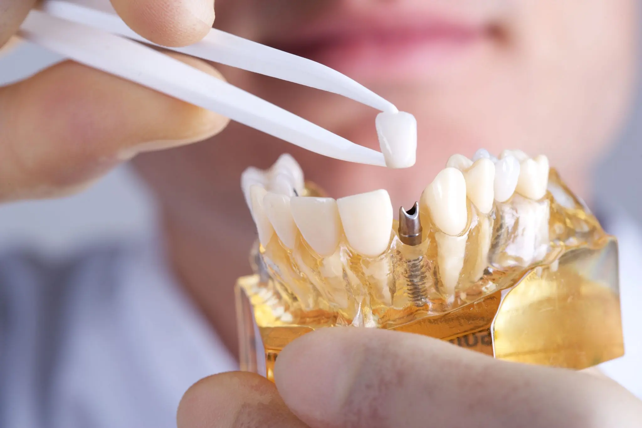 Dental implants in duncanville tx