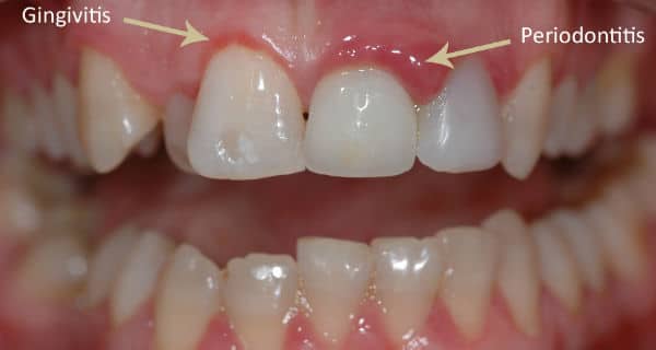 How To Treat Periodontal Disease With Natural Remedies