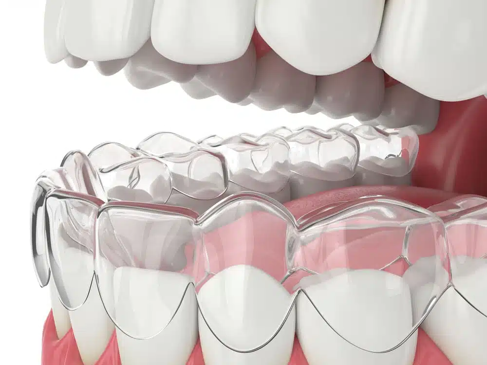 invisalign in duncanville tx