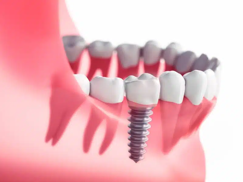 Example of a dental implant Dr. Singla would place