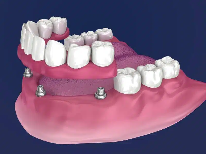 An illustration of full mouth dental implants
