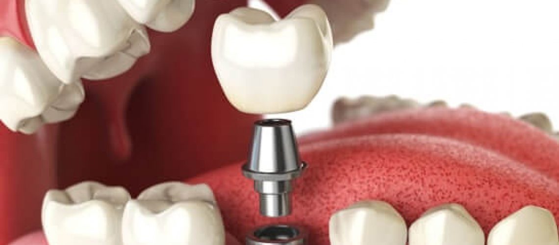candidate for Dental Implants